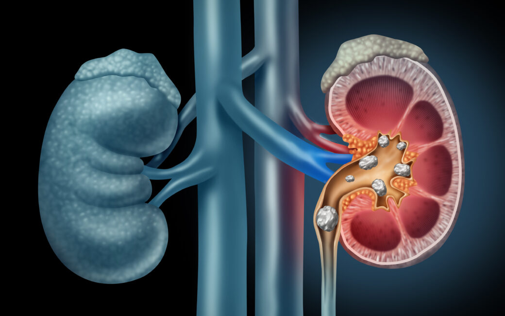 Human kidney Stones Medical Concept