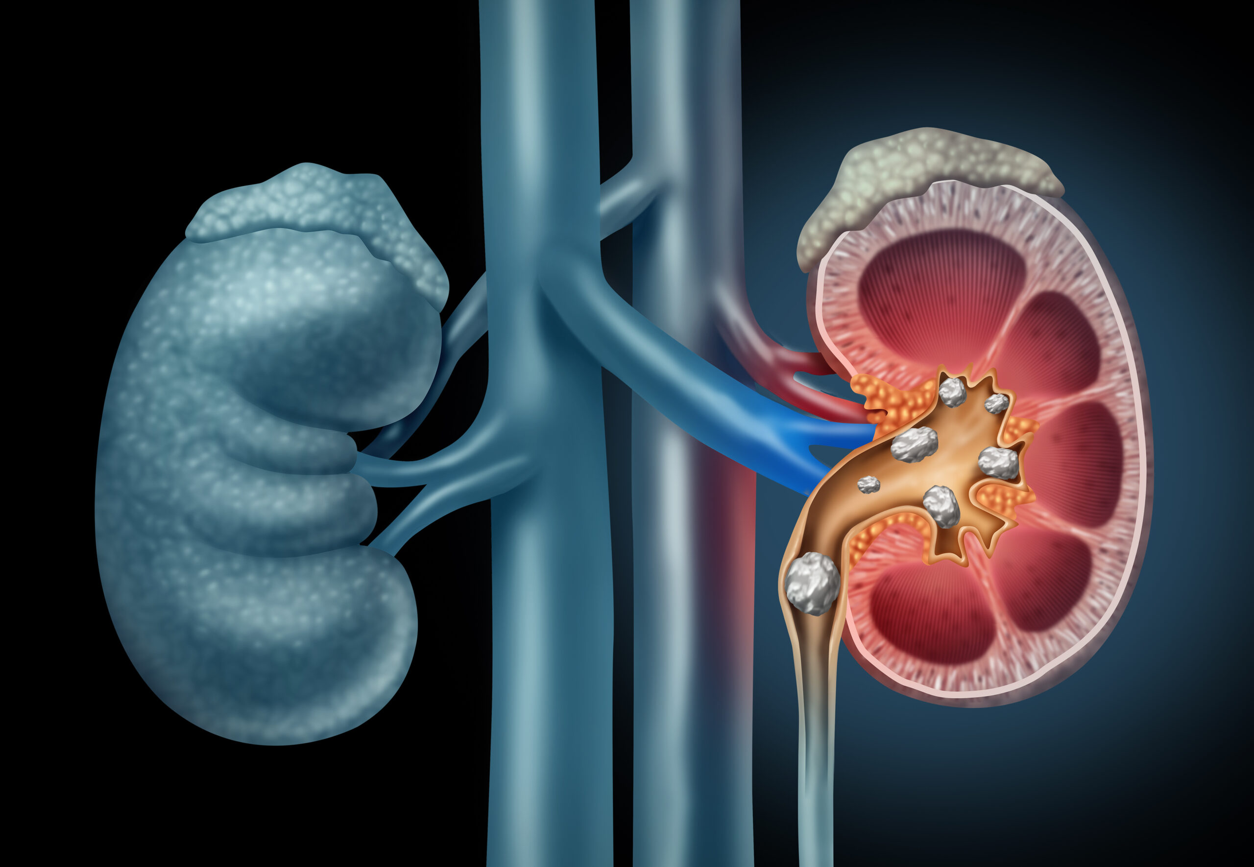 GHuman kidney Stones Medical Concept